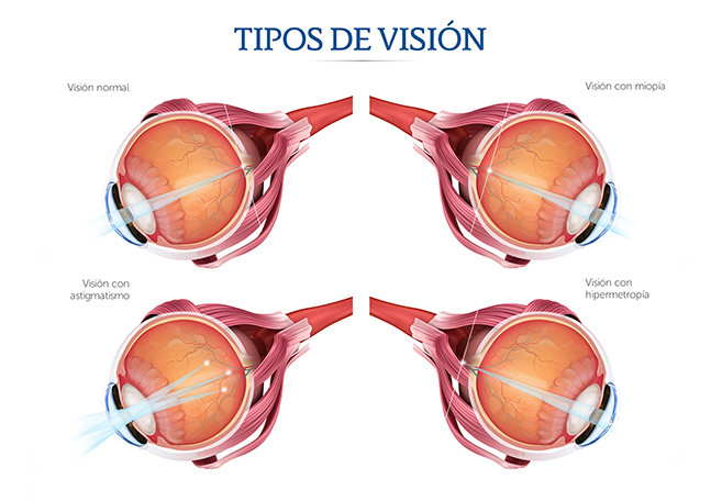 Esquema del ojo con visión normal, miopía, astigmatismo e hipermetropía.